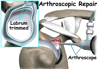 arthoscopic clinic at Chhabra Hospital