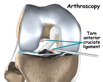 arthoscopic clinic at Chhabra Hospital