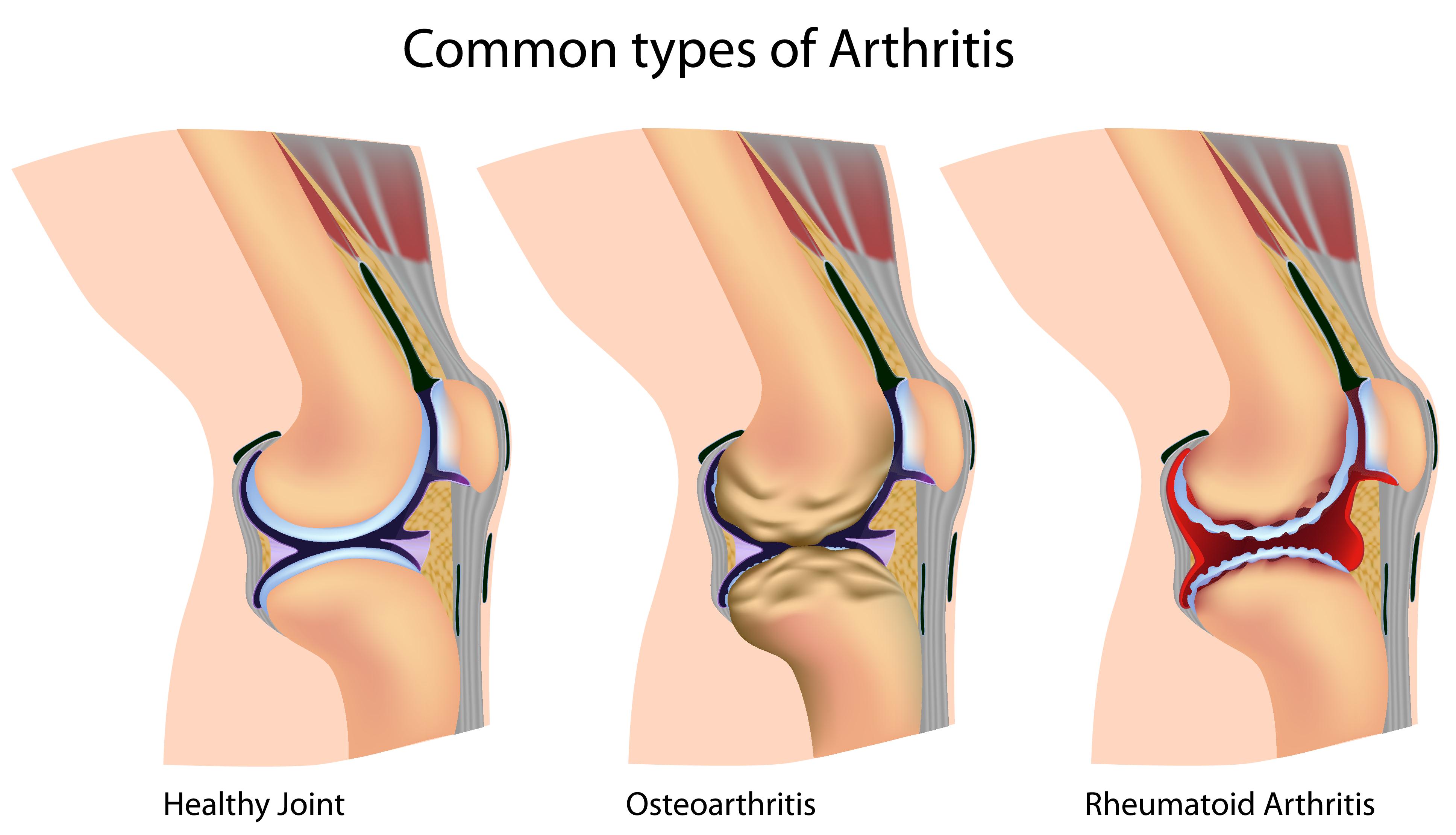 arthritis Chhabra Hospital