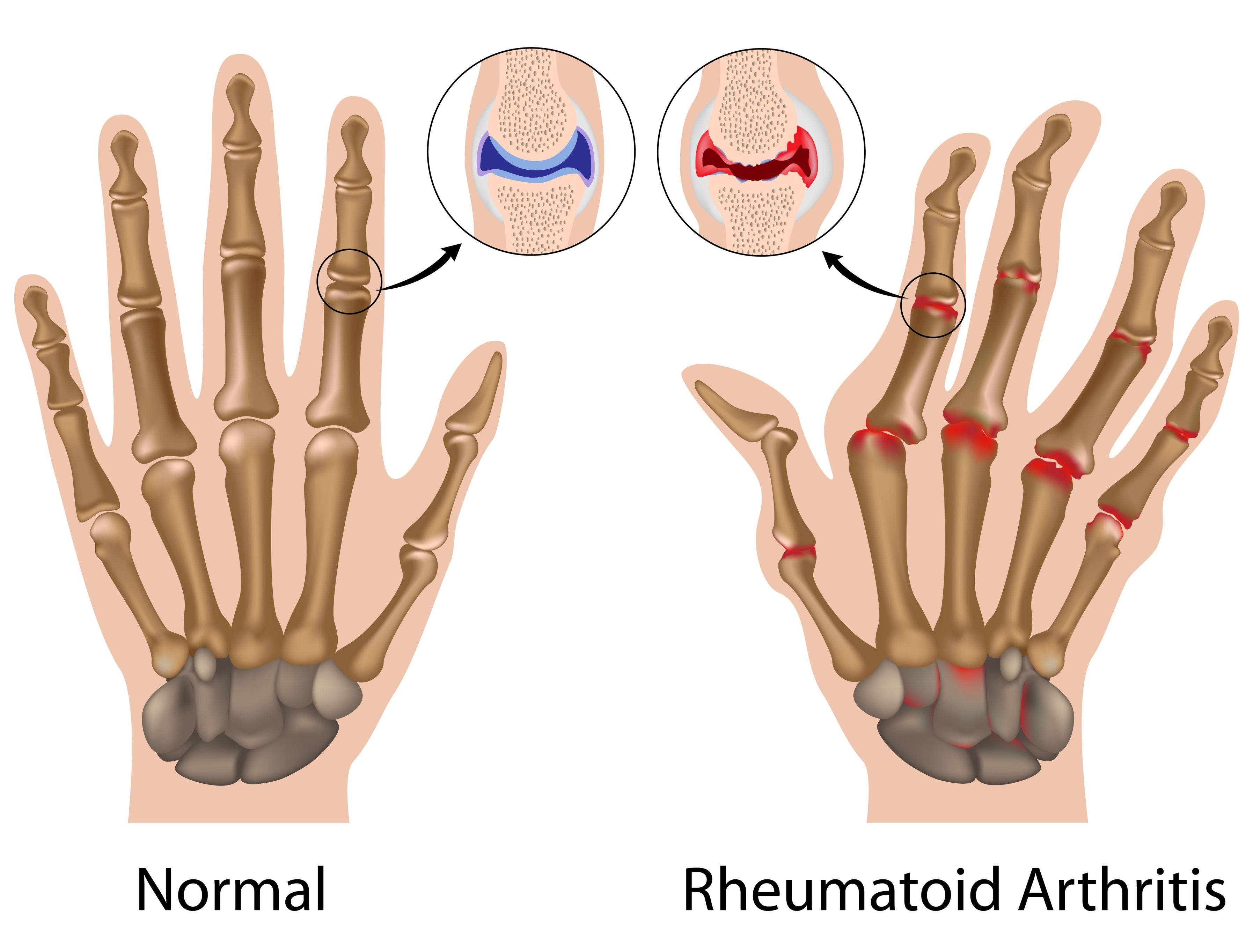 arthritis Chhabra Hospital