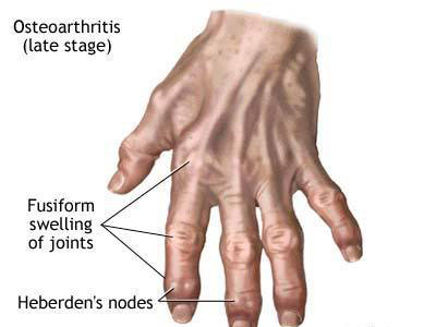 arthritis Chhabra Hospital