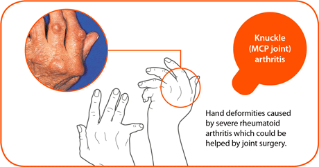 hand surgery Chhabra Hospital