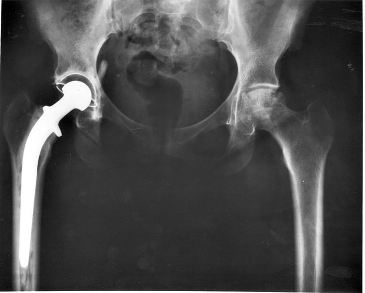 hip replacement Chhabra Hospital