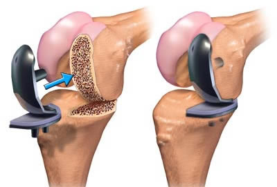 knee replacement Chhabra Hospital