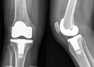 knee replacement Chhabra Hospital